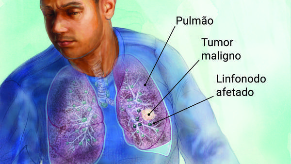Câncer de pulmão